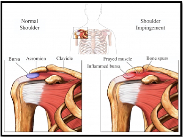 Swimmer’s Shoulder-Prevention and Dryland Training Strategies