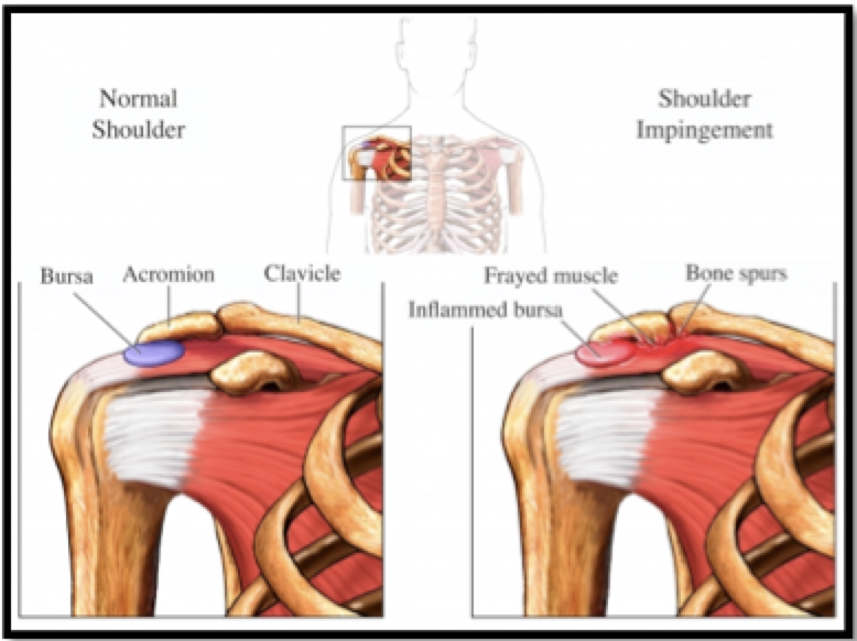 swimmer-s-shoulder-prevention-and-dryland-training-strategies