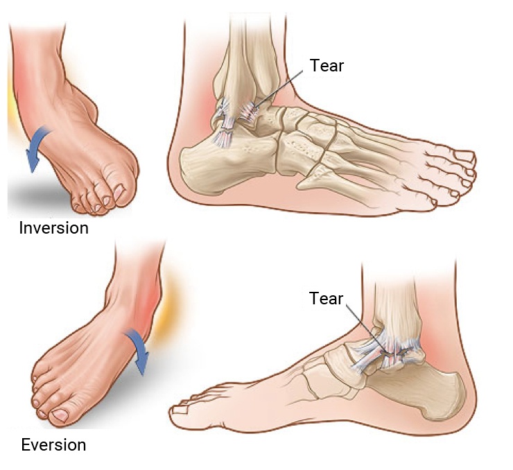 Preventing and Managing Ankle Sprains