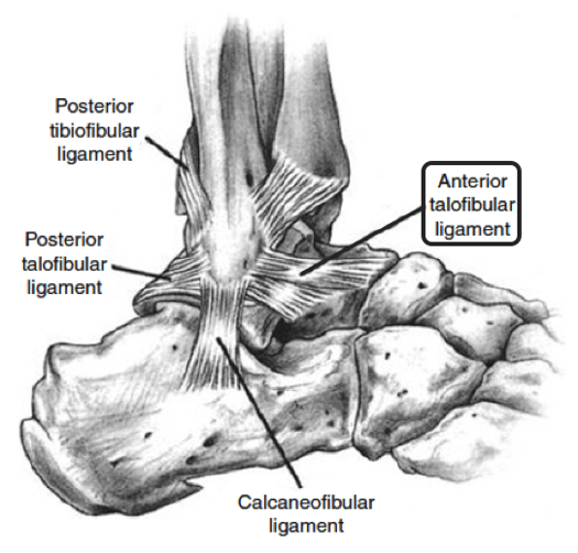 Preventing and Managing Ankle Sprains