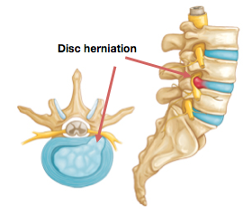 Figure 4 - Herniated Disc in Back