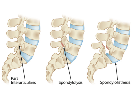 Pars Interarticularis and injuries